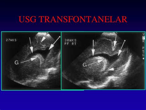 Transfontanelar Ultrasound Technique, Normal Anatomy